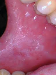 It was discovered that majority of the fibromas. Oral Pathology The Fibroma Breaking A Chronic Habit Registered Dental Hygienist Rdh Magazine