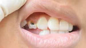 Si c'est le cas, c'est qu'il y a un problème, souvent une carie 8 x source de recherche. Un Dentifrice Qui Elimine Plus De La Moitie Des Caries Oui Et C Est Un Quebecois Qui L A Invente Rci Francais