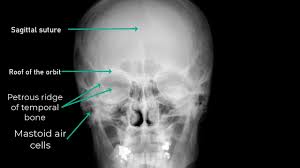 Image result for Skull XRay