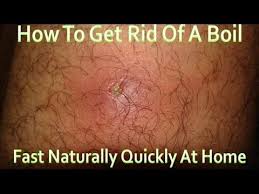 Pin On Armpit Boils