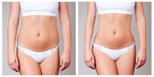 How Coolsculpting Banishes Stubborn Fat Deposits That Exercise And Diet Haven T Kentucky Skin Cancer Center Dermatologists