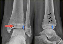 When people are involved in car accidents, the collision can sometimes be more serious than a simple fender bender. The Radiology Assistant Special Cases Of Ankle Fractures