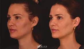 Transcutaneous Radiofrequency Microneedling in the Facial Plastic Surgeon's  Practice: A Review