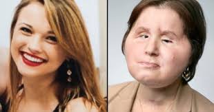 Katie probeerde uit leven te stappen toen ze 18 was. Ze krijgt 4 jaar later  tweede kans met historische gezichtstransplantatie