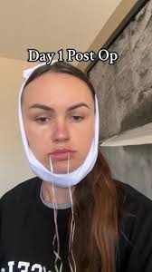 Bone Grafting Recovery Journey: Day 1 Post Op