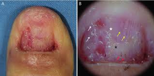 Image result for Onychotillomania feet