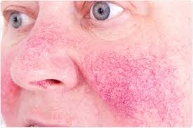 Cancer de la peau sur le nez. Rosacee Et Rhinophyma