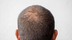 Punca rambut gugur di usia muda. Mengenal Dht Hormon Penyebab Kebotakan Rambut