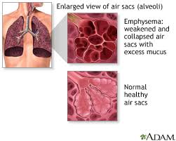 Exacerbations of copd cause significant morbidity and become more common with advancing age. Chronic Obstructive Pulmonary Disease Information Mount Sinai New York