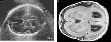 It is a form of cephalic disorder. Prenatal Ultrasound Findings Of Lissencephaly Associated With Miller Dieker Syndrome And Comparison With Pre And Postnatal Magnetic Resonance Imaging Fong 2004 Ultrasound In Obstetrics Amp Gynecology Wiley Online Library