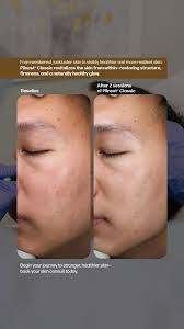 Visible transformation after just 2 sessions of Plinest® Classic 🌟,  Lackluster skin, lack of firmness, uneven texture—these are common  frustrations. With Plinest® Classic, we tap into advanced ...