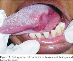 Both cases presented with oral ulceration as their primary symptom, but careful history‐taking and other features raised suspicion of possible secondary syphilis. Scielo Brasil Ulcerative Lesions Of The Mouth An Update For The General Medical Practitioner Ulcerative Lesions Of The Mouth An Update For The General Medical Practitioner