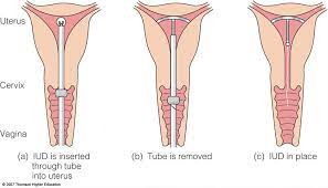 How long does iud pain last. What To Expect When Getting An Iud Teen Health Source