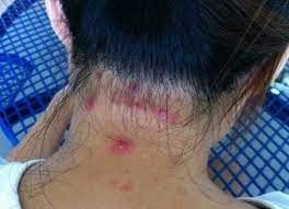 These pimples can be itchy and sore. Scalp Acne Treatment Causes And Prevention