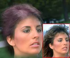 Acupuncture for hair loss in females female pattern hair loss, a common type of hair loss in women, is also the result of genetic factors and changes in hormones. Hair Loss In Women Consulting Doctor