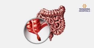 We did not find results for: Laparoscopic Appendix Removal Surgery