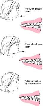 Malocclusions Definition Of Malocclusions By Medical Dictionary Medical Dictionary Orthodontic Appliances Medical Terms