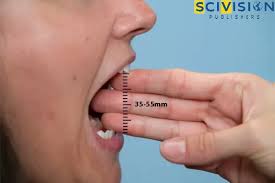 Image result for Trismus