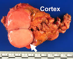 Overview Of Adrenal Metastasis