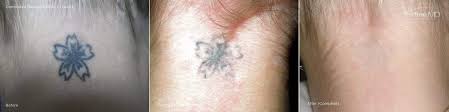 Tattoo removal has been performed with various tools since the start of tattooing. Tattoo Removal Inkfree Md Laser Clinic Houston Tx