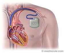 Keep headphones at least six inches away from your icd or pacemaker. Icd Shocks Hurt Quality Of Life Sudden Cardiac Arrest Foundation