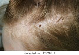 Image result for white scabs on the head in children