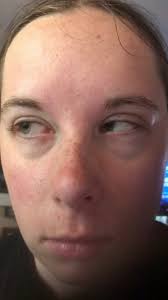 Can anyone offer any insight as to why my left eye is going inward more  than my right when I look to the right?, Is this something I should address  with my ophthalmologist or neuro-opthamology?, For ...