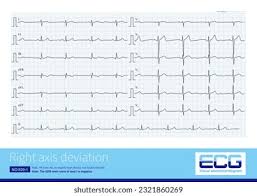 Image result for Right Axis Deviation