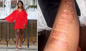 A few different side effects can appear after laser hair removal. Graduate 22 Scarred For Life By Laser Hair Removal Treatment Caused Second Degree Burns On Her Leg Daily Mail Online