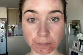 The emotional toll of having acne in your late 20s.