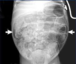 Image result for Necrotizing Enterocolitis