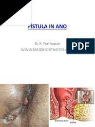 Immerse yourself in our outstanding academics. Fistula In Ano Medical Specialties Health Sciences