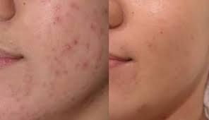 Laser skin resurfacing removes the outer layer of skin to stimulate new cell growth. Skin Sensations Acne Breakouts Pimples