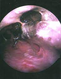 Médicos de la india revelaron que algunos pacientes con coronavirus han presentado una infección… Rhinocerebral Mucormycosis A Retrospective Study Springerlink