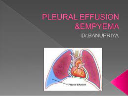 We did not find results for: 20 5 Pleural Effusion Amp Empyema
