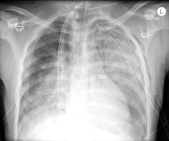 Image result for Pulmonary Contusion