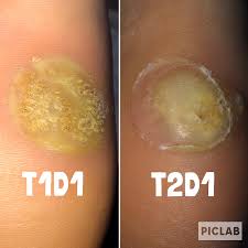 You will have no pain, no burning sensation or side effects at all. 1 Day After 1st Cantharidin Treatment Vs 1 Day After 2nd Cantharidin Treatment 3 Weeks Have Passed Warts