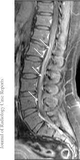 It is the most common cause of rapidly progressive flaccid paralysis. Figure 6 From Spinal Mri Findings Of Guillain Barre Syndrome Semantic Scholar