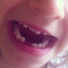 Se Deben Arrancar Los Dientes De Leche Tambaleantes