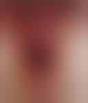 Image result for Urethral Prolapse