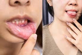 Image result for mouth ulcer on tongue)