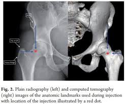 Image result for Hip Injection