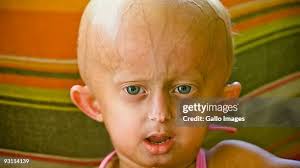 206 Progeria Stock Photos, High-Res Pictures, and Images