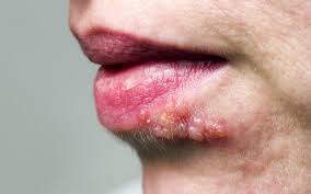 Zona zoster (herpes zoster) este o infecție virală ce afectează rădăcinile nervoase. Zona Zoster Divahair Ro