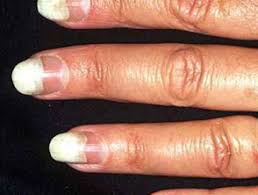 In some cases, a small collection of pus forms under the skin next to the nail, or underneath the nail itself. Onycholysis Dermnet Nz
