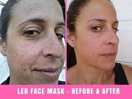 I have good news for you. Project E Beauty Led Face Mask Before And After 30 Days