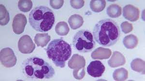 Leucemia fulminante, riconoscere i sintomi e modalità di intervento. Leucemia Fulminante Que Es Causas Sintomas En Adultos Y Mas