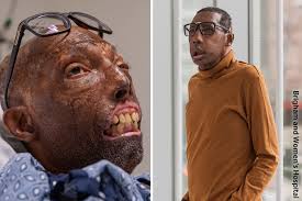 Melodramatic pop punk our instagram & twitter fanpage ready. First African American Face Transplant Performed