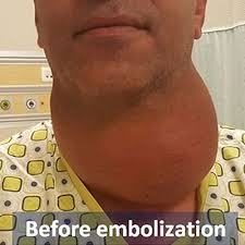 Image result for Goiter