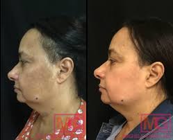 Image result for Melasma calycinum